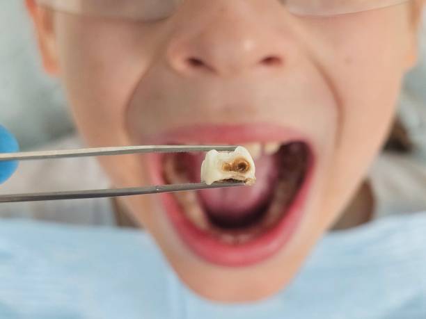 Best Chipped Tooth Repair Near Me  in Morgantown, MS
